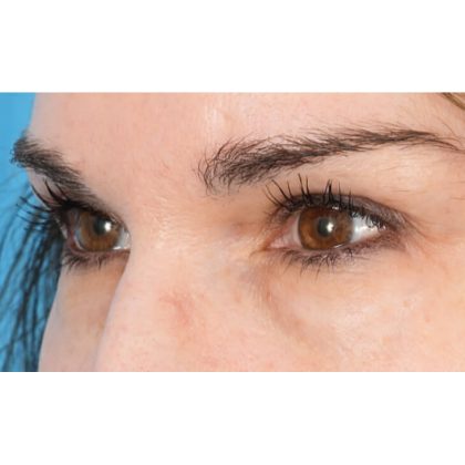 Lower Blepharoplasty Before & After Patient #1676