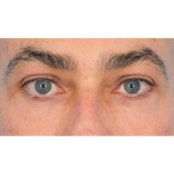 Lower Blepharoplasty Before & After Patient #1694