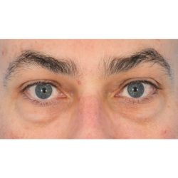 Lower Blepharoplasty Before & After Patient #1694