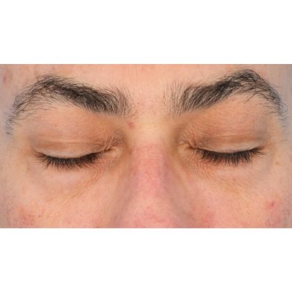 Lower Blepharoplasty Before & After Patient #1694