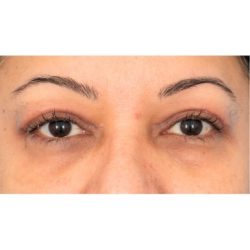 Upper Blepharoplasty Before & After Patient #1576