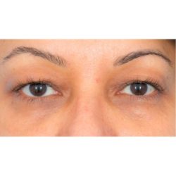 Upper Blepharoplasty Before & After Patient #1576