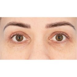 Upper Blepharoplasty Before & After Patient #1591