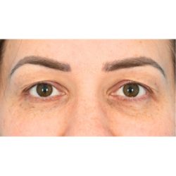Upper Blepharoplasty Before & After Patient #1591