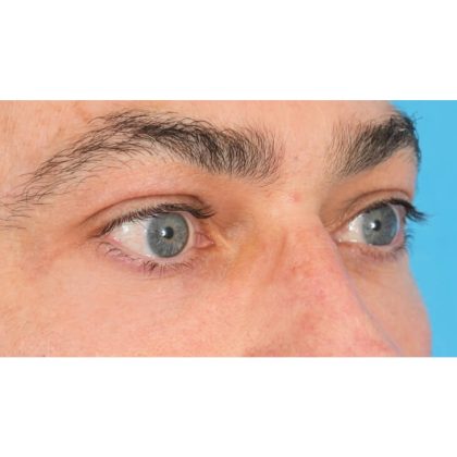 Lower Blepharoplasty Before & After Patient #1694