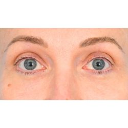 Lower Blepharoplasty Before & After Patient #861