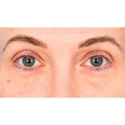 Lower Blepharoplasty Before & After Patient #861