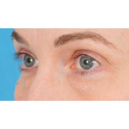 Lower Blepharoplasty Before & After Patient #861