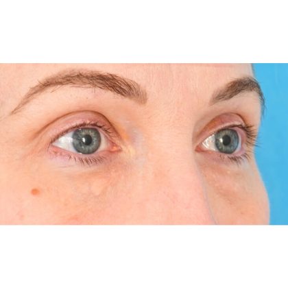 Lower Blepharoplasty Before & After Patient #861
