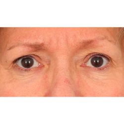 Lower Blepharoplasty Before & After Patient #1718