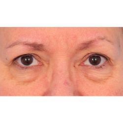 Lower Blepharoplasty Before & After Patient #1718