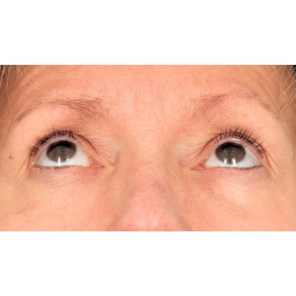 Lower Blepharoplasty Before & After Patient #1718