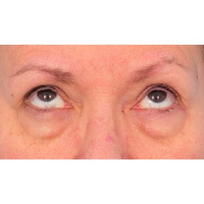Lower Blepharoplasty Before & After Patient #1718