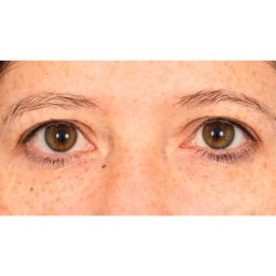 Lower Blepharoplasty Before & After Patient #1727