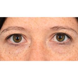 Lower Blepharoplasty Before & After Patient #1727