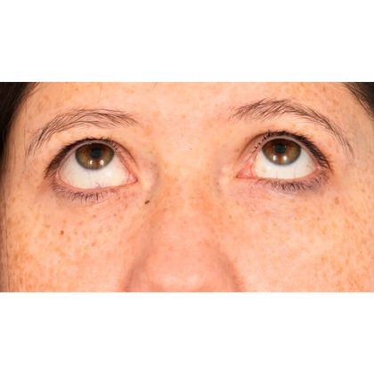 Lower Blepharoplasty Before & After Patient #1727