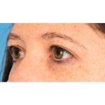 Lower Blepharoplasty Before & After Patient #1727