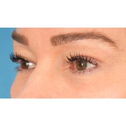 Lower Blepharoplasty Before & After Patient #1736