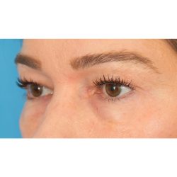 Lower Blepharoplasty Before & After Patient #1736