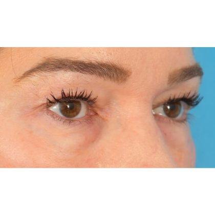 Lower Blepharoplasty Before & After Patient #1736