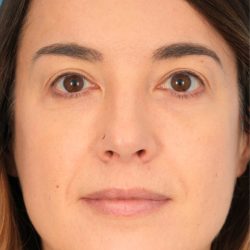 Lower Blepharoplasty Before & After Patient #1741
