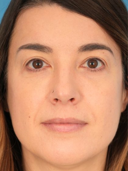 Lower Blepharoplasty Before & After Patient #1741