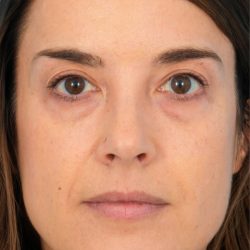 Lower Blepharoplasty Before & After Patient #1741