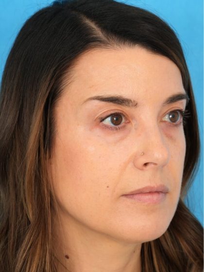 Lower Blepharoplasty Before & After Patient #1741