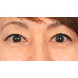 Lower Blepharoplasty Before & After Patient #1748