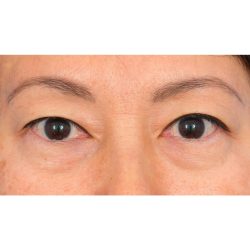Lower Blepharoplasty Before & After Patient #1748