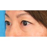 Lower Blepharoplasty Before & After Patient #1748