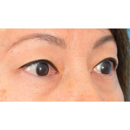 Lower Blepharoplasty Before & After Patient #1748