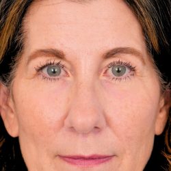Lower Blepharoplasty Before & After Patient #525