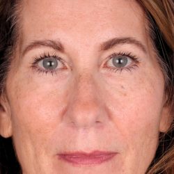 Lower Blepharoplasty Before & After Patient #525