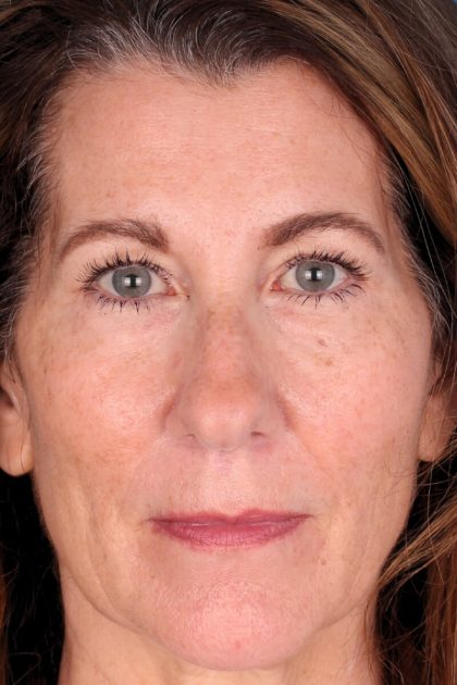 Lower Blepharoplasty Before & After Patient #525