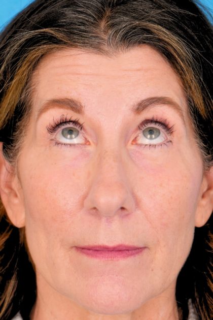 Lower Blepharoplasty Before & After Patient #525