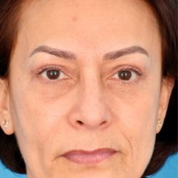 Quad Blepharoplasty Before & After Patient #1709