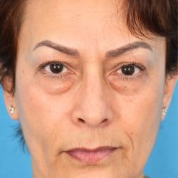 Quad Blepharoplasty Before & After Patient #1709