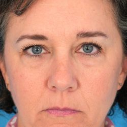 Quad Blepharoplasty Before & After Patient #1825