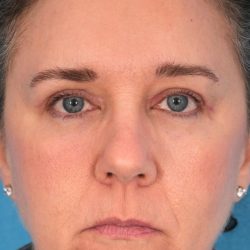 Quad Blepharoplasty Before & After Patient #1825