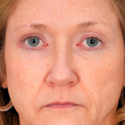 Quad Blepharoplasty Before & After Patient #1966