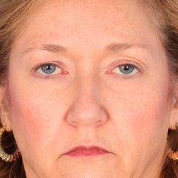 Quad Blepharoplasty Before & After Patient #1966