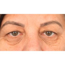 Quad Blepharoplasty Before & After Patient #1939