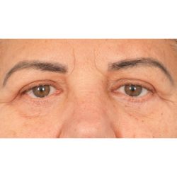 Quad Blepharoplasty Before & After Patient #1939