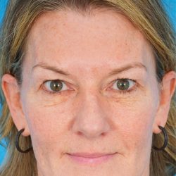 CO2 Laser Resurfacing Before & After Patient #1997