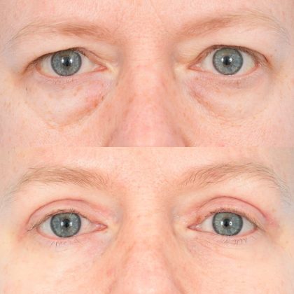 Best Quad Blepharoplasty Chicago, IL | Chicago Oculofacial Plastic Surgery