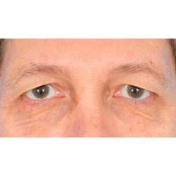 Upper Blepharoplasty Before & After Patient #1857