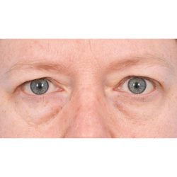 Quad Blepharoplasty Before & After Patient #1810