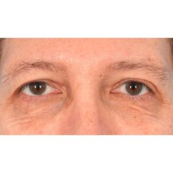 Upper Blepharoplasty Before & After Patient #1857