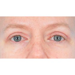 Quad Blepharoplasty Before & After Patient #1810